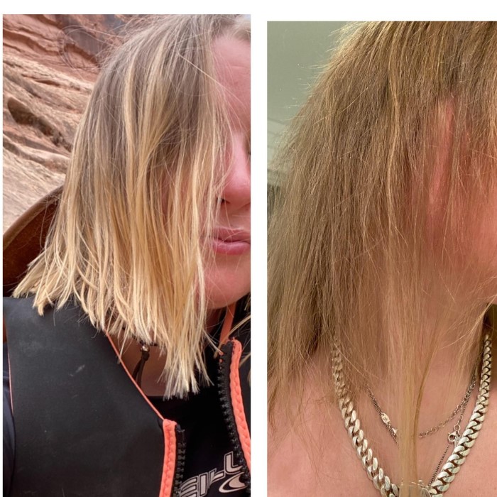 accutane hair loss before and after
